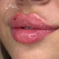 آف ژل لب بوتاکس فیلر بینی انزیم