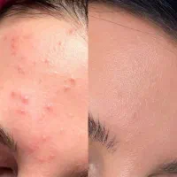 ضد جوش ایتالیایی بابیوممتیک