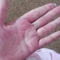 پسوریازیس و اگزما