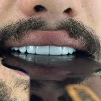 کامپوزیت و زیبایی دندان