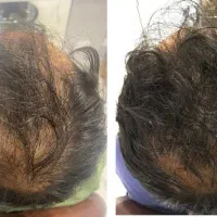 35 روزه پرپشتش کن