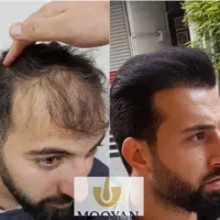 کاشت مو ۲۲ و کاشت ابرو ۱۵