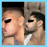 ریش کم تراکم داری اینو ببین