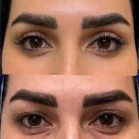 جراحی افتادگی پلک(بلفاروپلاستی)لیفت صورت و شقیقه