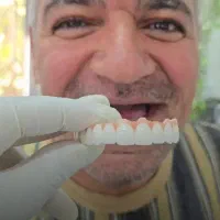 ایمپلنت اقساطی
