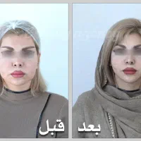 MACS LiFT/لیفت صورت/بلفارو/عمل بینی/نقد و اقساط