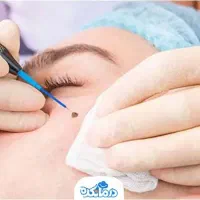 برداشت خال و گوشت اضافی صورت و بدن