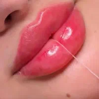 یه مدت سه روز بوتاکس مصپورت با شارژ رایگان فقط ۷۰۰