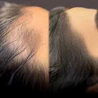 اسکالپ فوق تخصصی کفسر در کلینیک پزشک پوشش کم پشتی