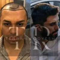 جشنواره یلدایی کاشت مو در تهران یک روزه