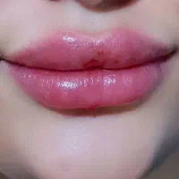 آف ویژه ژل ، بوتاکس ، پی آر پی
