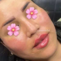 ژل و بوتاکس و پیرسینگ رایگان