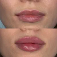 تزریق ژل لب و صورت با ظاهری طبیعی