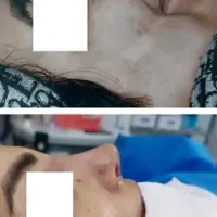 عمل بینی/سانترال لب/بلفارو پلاستی|خدمات آرایشگری و زیبایی|مشهد, احمدآباد|دیوار