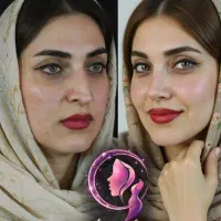تخفیف ۲۰ ملیونی جراحی بینی ، توسط فوق تخصص