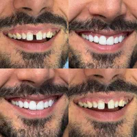 آف خدمات زیبایی کامپوزیت دندان