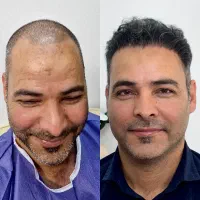 کاشت مو با متد SuperFUE، متد شیرازی دکتر چالشی