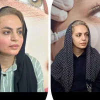 تخفیفات بی نظیر ژل وبوتاکس فقط ۱میلیون