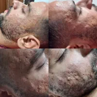 رفع جای سالک جوش ردبخیه بلفارو قطع ریزش مو