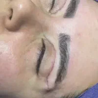 اندولیفت بلفاروجراحی پلک ابرو اندولیفت