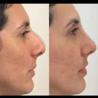 ژل لب بینی کانتورینگ بلفارو غبغب لیفت شقیقه ابرو