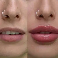 بوتاکس ۱۱۰۰ لاغری ۳۹۰ ژل ۱۲۰۰ هایفو ۹۵۰