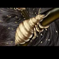 پاکسازی رشک و شپش با دستگاه
