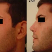 جراحی عمل بینی پیکر تراشی لیپو ابدو مامو پروتز|خدمات آرایشگری و زیبایی|تهران, یوسف‌آباد|دیوار