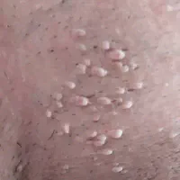 بهبود ریشه ای زگیل و تبخال تناسلی