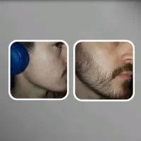 فولیکول سازی ریش