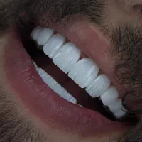ایمپلنت ، لمینت ،کامپوزیت دوفک ۱۰میلیون اقساطی