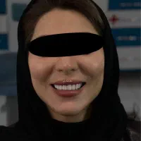 کامپوزیت زیبایی دندان