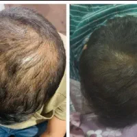 قطع ریزش مو برای همیشه