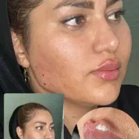 ژل بوتاکس فیلر لیزر پی آرپی فیلربادی