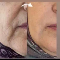 خداحافظی با چروک