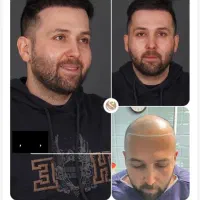 کاشت مو با ضمانت قطعی