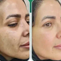 فشیال و مزو دست وصورت