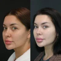 فستیوال زیبایی شرایط ویژه جراحی بینی