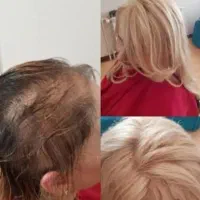 پروتز مو طبیعی آقایون و بانوان