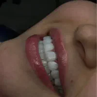تخفیفات ویژه لبخند هالیوودی
