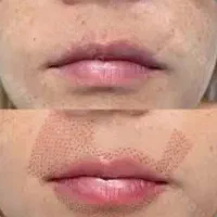 پلاسما رفع چروک  صورت  وپلک وکوچک کردن بینی