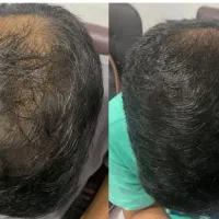 رویش مجدد مو کاملا تضمینی
