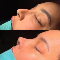 با ۱۰ میلیون عمل بینی