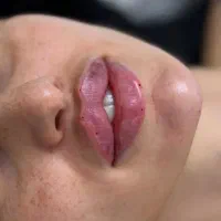خدمات فیلر و بوتاکس و انزیم
