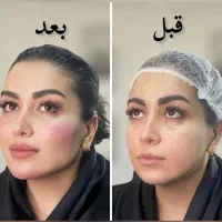 ساکشن غبغب ، لیفت با نخ و کانتورینگ صورت
