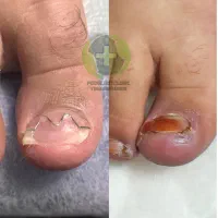 کیلنیک تخصصی درمان ناخن و بیماری های پابدون جراحی