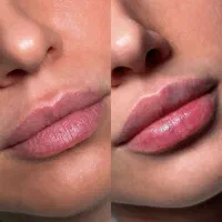 تزریق تخصصی بوتاکس،فیلر،مزو،پی ارپی