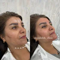 ژل فیلر و بوتاکس تخصصی