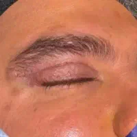 بلفاروپلاستی چشم ویژه، پره بینی