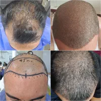 تیم کاشت مو شیرازی در اصفهان